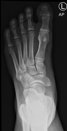 Cornuate navicular | Radiology Case | Radiopaedia.org