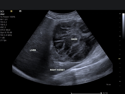 Renal Mass 