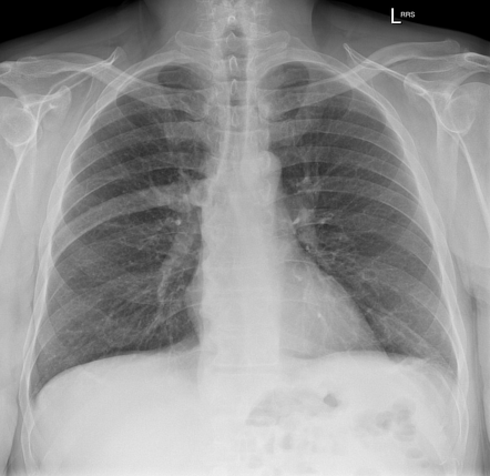 Paget disease of the rib | Radiology Case | Radiopaedia.org