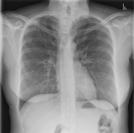 Severe tracheal narrowing due to multinodular goiter following FNA ...