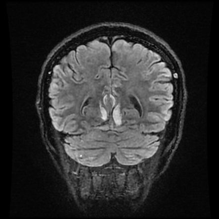 Aliasing artifact on MRI (wrap-around) | Radiology Case | Radiopaedia.org