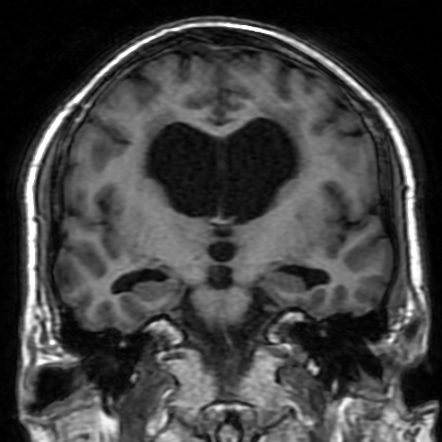 Post-hydrocephalus corpus callosum damage | Radiology Case ...