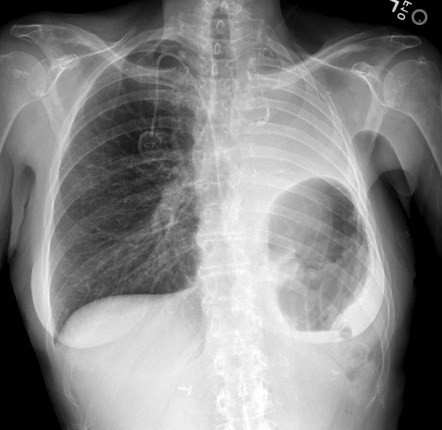 Pneumonectomy | Radiology Case | Radiopaedia.org