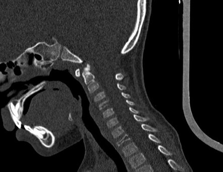 Vertebra plana | Radiology Case | Radiopaedia.org