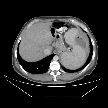 Post Sleeve Gastrectomy With Abscess | Radiology Case | Radiopaedia.org