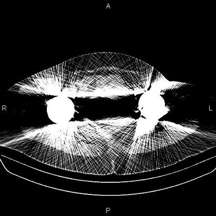 Beam Hardening Streaking Artifact Radiology Case Radiopaedia Org