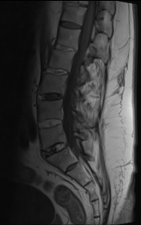 Ankylosing spondylitis | Radiology Case | Radiopaedia.org