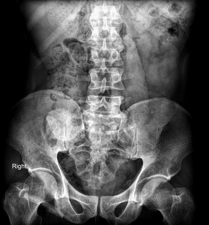 Urolithiasis | Radiology Reference Article | Radiopaedia.org