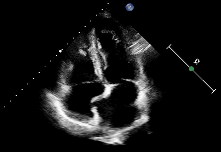 Atrial septal aneurysm - type 1R | Radiology Case | Radiopaedia.org