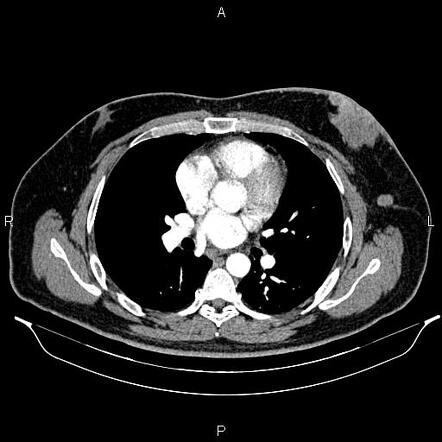 Multifocal invasive ductal carcinoma of the breast - male | Radiology ...