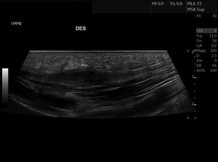 Plantar fibromatosis | Radiology Case | Radiopaedia.org