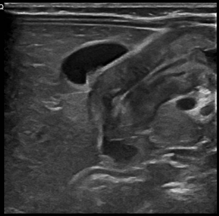 Hypertrophic Pyloric Stenosis Radiology Case Radiopaedia Org