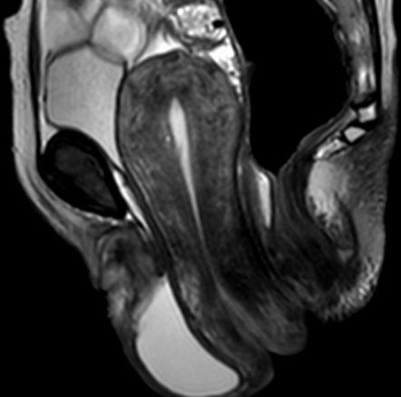 Uterine prolapse with large cystocele | Radiology Case | Radiopaedia.org