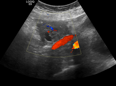 Ectopic pregnancy | Radiology Case | Radiopaedia.org