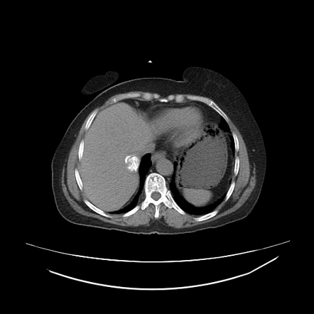 Calcified hepatic hydatid cyst | Radiology Case | Radiopaedia.org