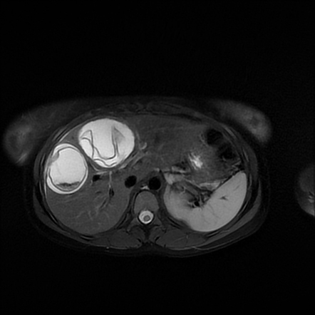 Water lily sign - hepatic hydatid cysts | Radiology Case | Radiopaedia.org