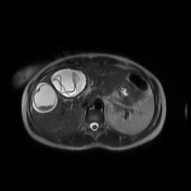 Water-lily sign (hydatid cyst) | Radiology Reference Article ...