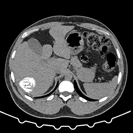 Calcified hepatic hydatid cyst | Radiology Case | Radiopaedia.org