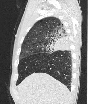 Haemophilus pneumonia | Radiology Case | Radiopaedia.org