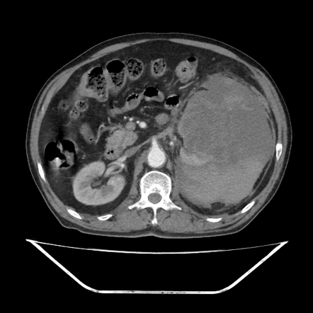 Renal mass with post biopsy perinephric hematoma | Radiology Case ...