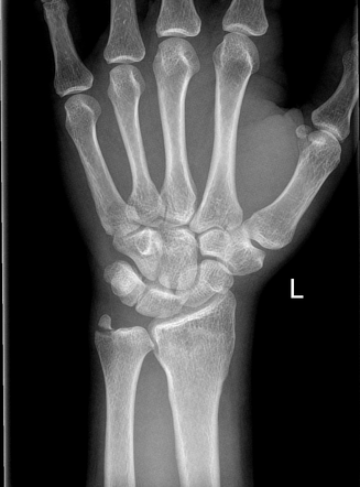 Distal radial fracture | Radiology Case | Radiopaedia.org