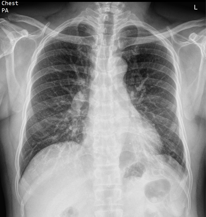 Bronchiectasis | Radiology Case | Radiopaedia.org