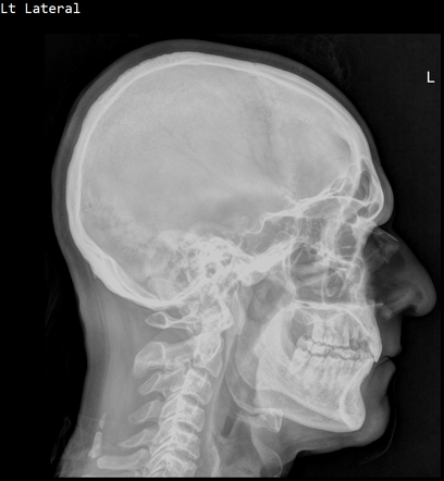 Nuchal ligament ossification | Radiology Case | Radiopaedia.org