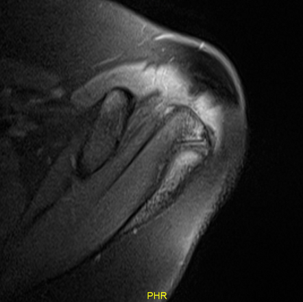 acromion types mri