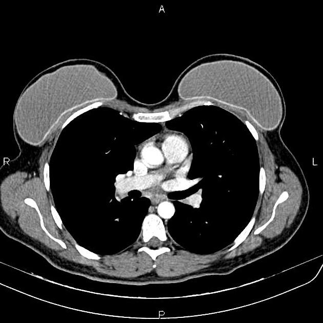 Breast implants, Radiology Reference Article