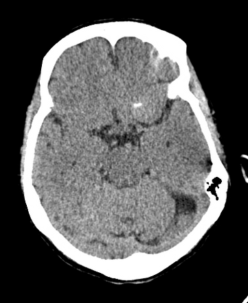 Vertebrobasilar dolichoectasia and incidental meningioma | Radiology ...