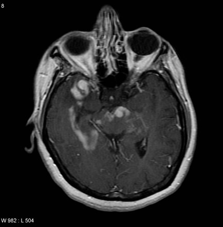 Primary CNS lymphoma | Radiology Case | Radiopaedia.org