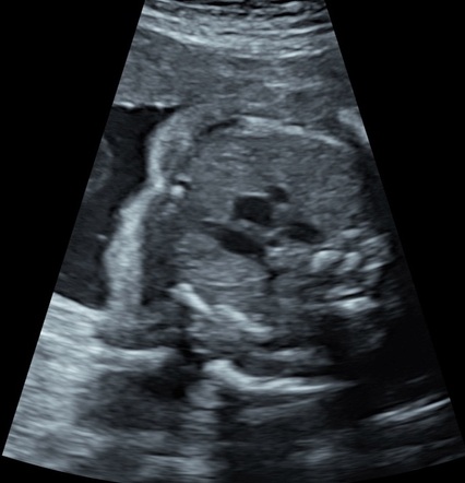 Right-sided aortic arch (antenatal ultrasound) | Radiology Case ...