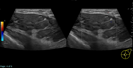 Giant fibroadenoma | Radiology Case | Radiopaedia.org