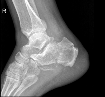 Calcaneum fracture | Radiology Case | Radiopaedia.org