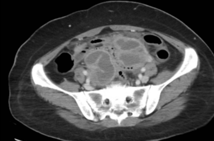 Tubo-ovarian Abscesses | Radiology Case | Radiopaedia.org