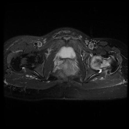 Transient Hip Osteoporosis 