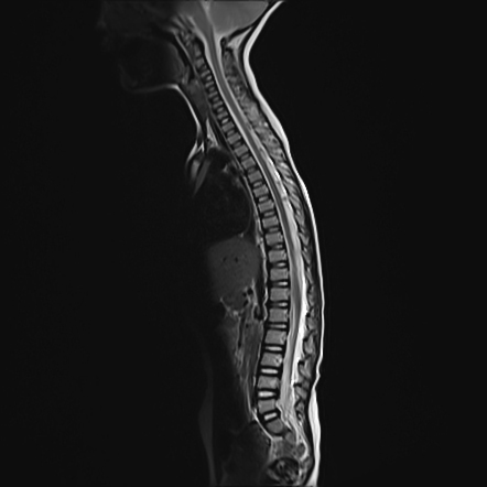 Normal spine MRI - 2-year-old | Radiology Case | Radiopaedia.org