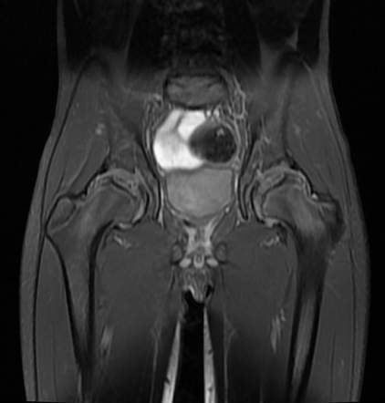 Legg-Calvé-Perthes disease - biateral | Radiology Case | Radiopaedia.org