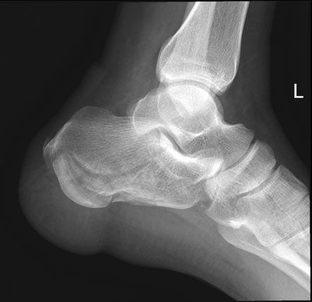 Calcaneum fracture | Radiology Case | Radiopaedia.org