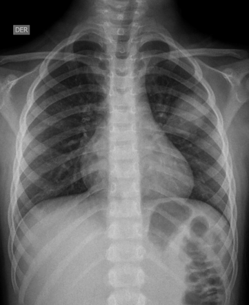 Round pneumonia | Radiology Case | Radiopaedia.org