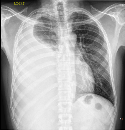 Pleural Effusion 