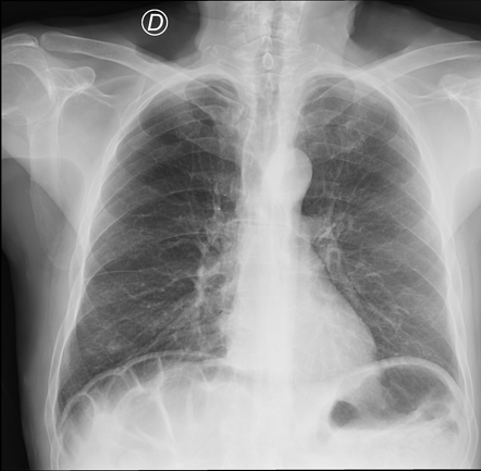 Chilaiditi sign (chest x-ray) | Radiology Case | Radiopaedia.org