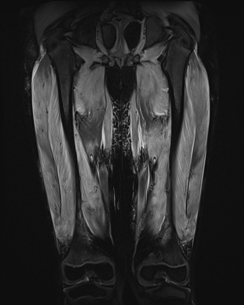 Myositis | Radiology Case | Radiopaedia.org