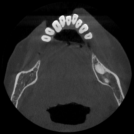 Periapical cyst - large | Radiology Case | Radiopaedia.org