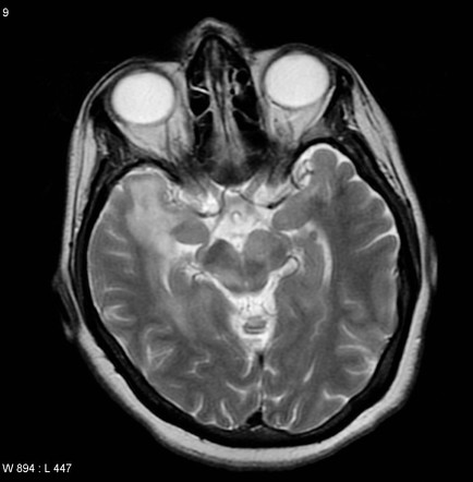 Primary CNS lymphoma | Image | Radiopaedia.org