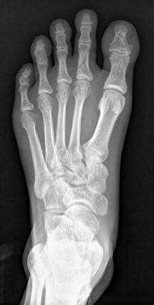 Proximal Phalanx Fracture Radiology Case Radiopaedia Org