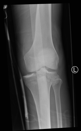 Tibial plateau fracture | Radiology Case | Radiopaedia.org