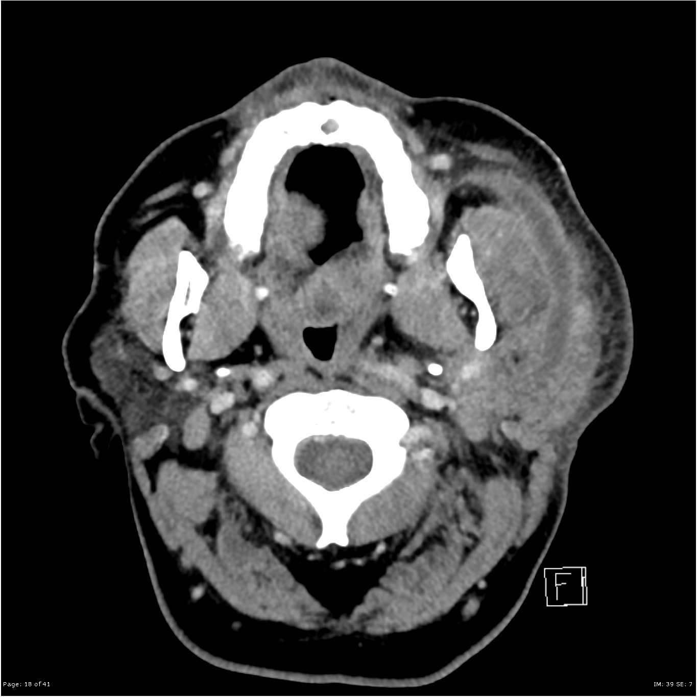 Parotid Duct Stone Image