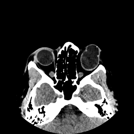 Congenital corneal staphyloma | Radiology Case | Radiopaedia.org