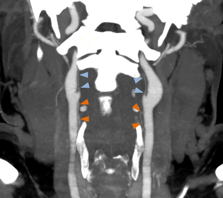 Bilateral superior pharyngeal artery from common carotid artery and ...